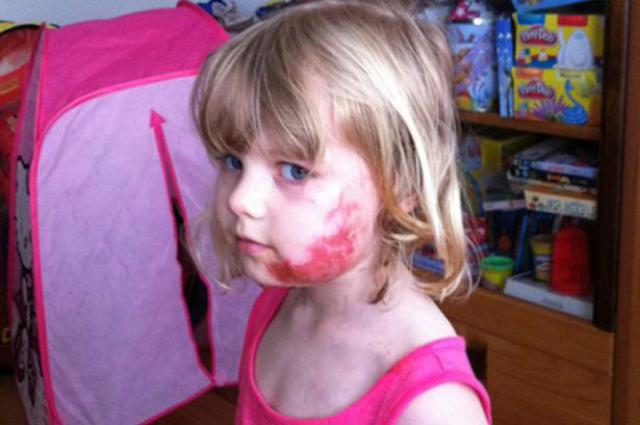 Une gamine défigurée par l'airbag d'un avion de Virgin